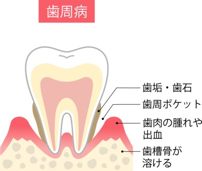 歯周病のしくみ　断面図
